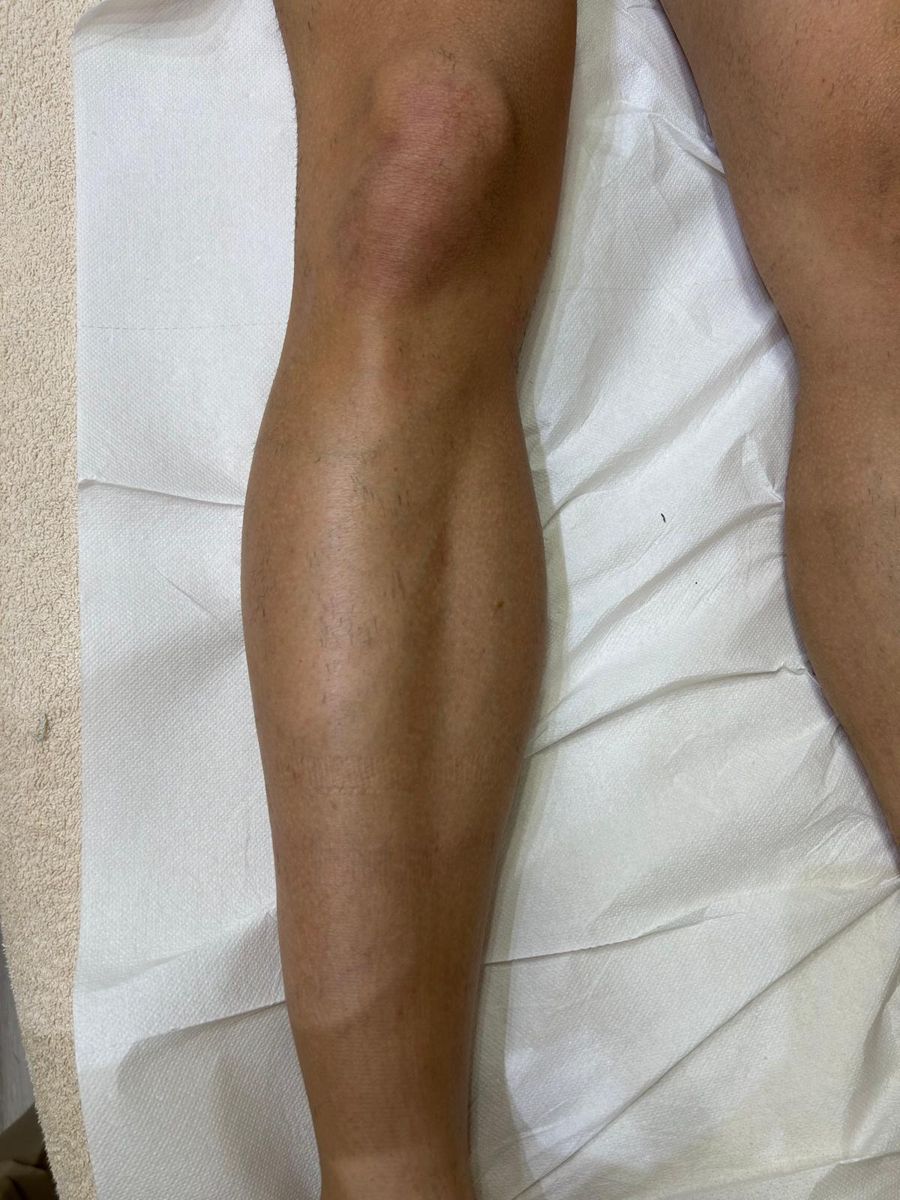 Epilazione laser, gamba, dopo 2 sedute