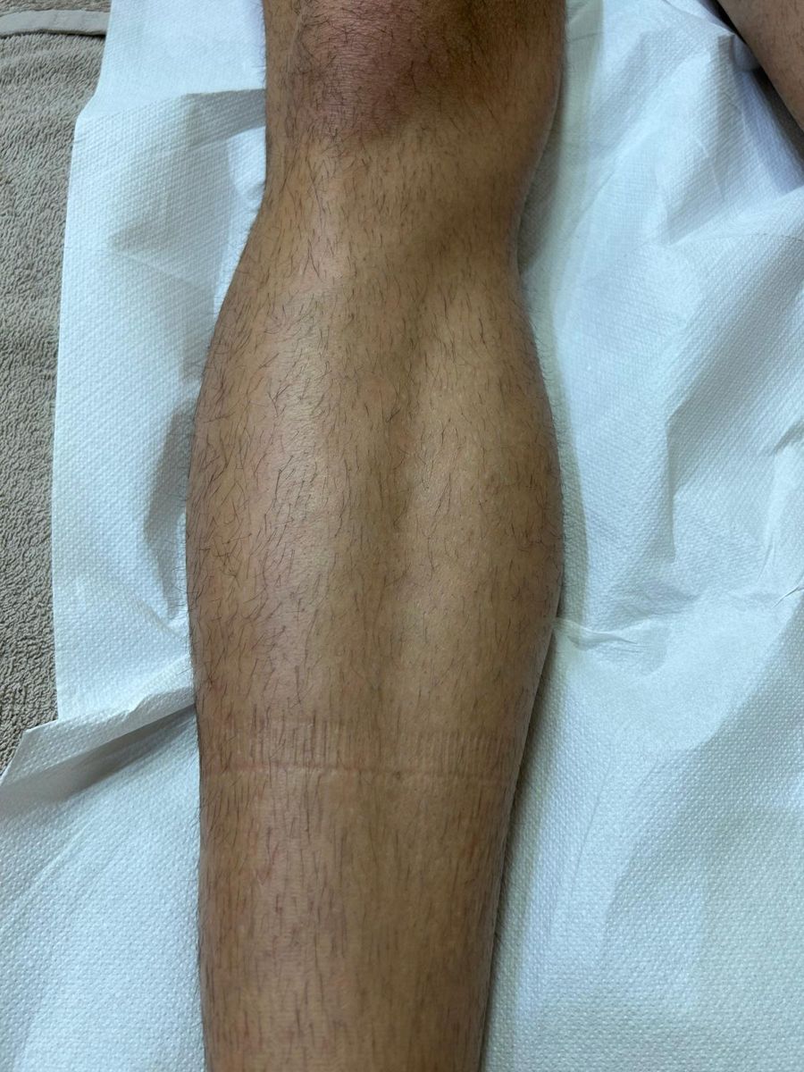 Epilazione laser, gamba, prima