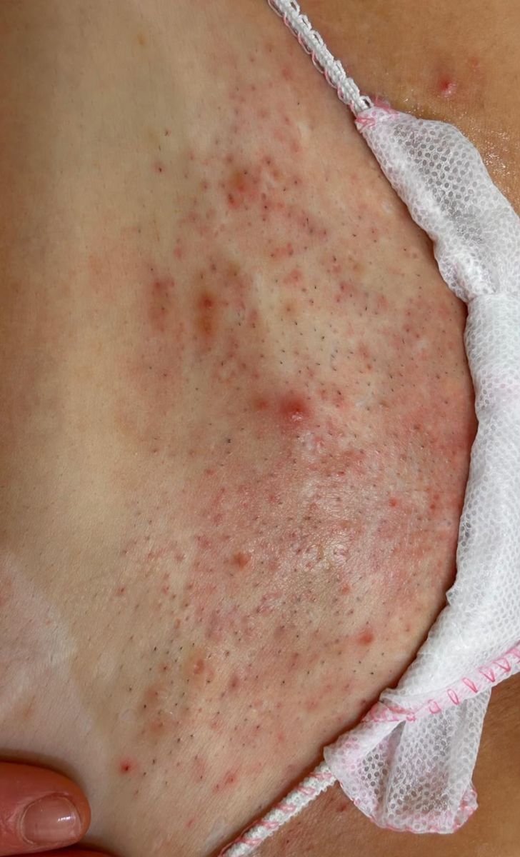 Epilazione laser, inguine, prima